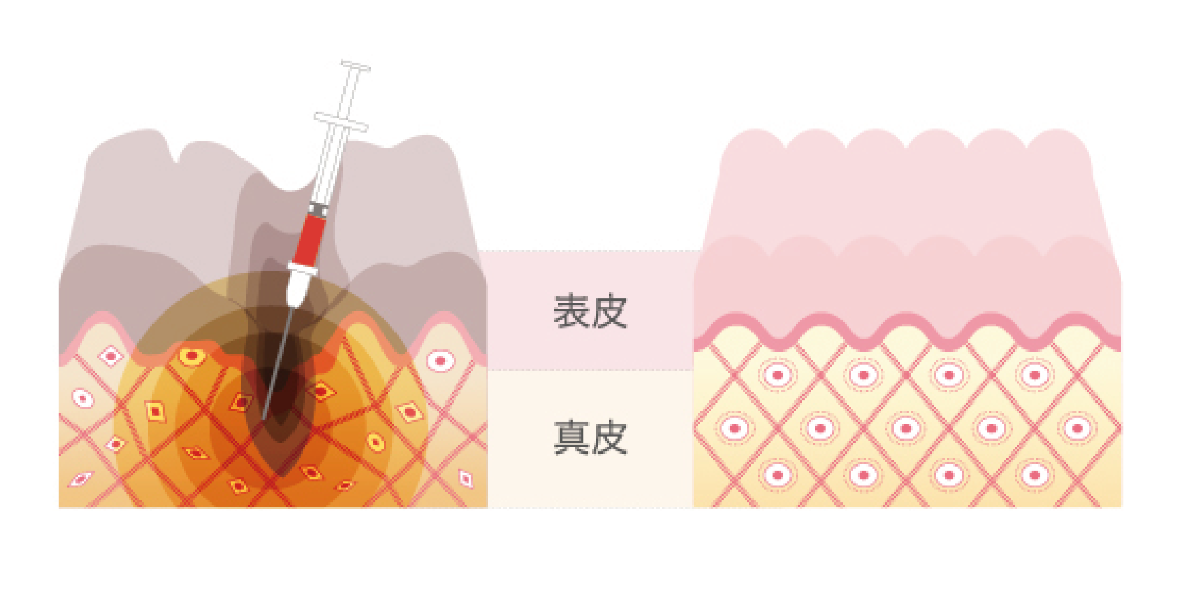 症状に合わせて２つの注入方法が選択できます。