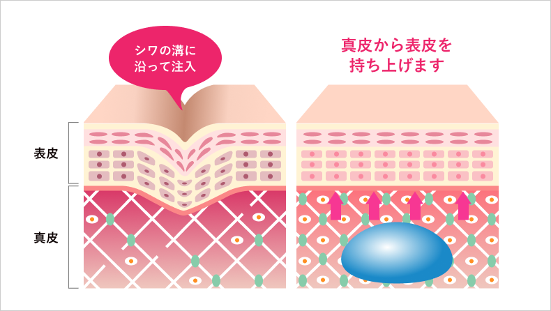 シワへの注入による改善メカニズム図解 シワの溝に沿って注入 真皮から表皮を持ち上げます
