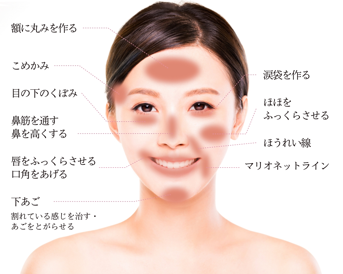 額に丸みを作る, こめかみ, 目の下のくぼみ, 涙袋を作る, 鼻筋を通す, 鼻を高くする, ほほをふっくらさせる, ほうれい線, 唇をふっくらさせる, 口角をあげる, マリオネットライン, 下あご 割れている感じを治す・あごをとがらせる