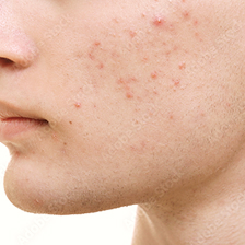 メンズニキビ・肌美容
