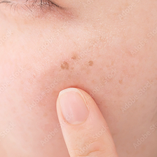 シミ・肝斑・ホクロ・イボ