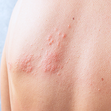 アトピー性皮膚炎