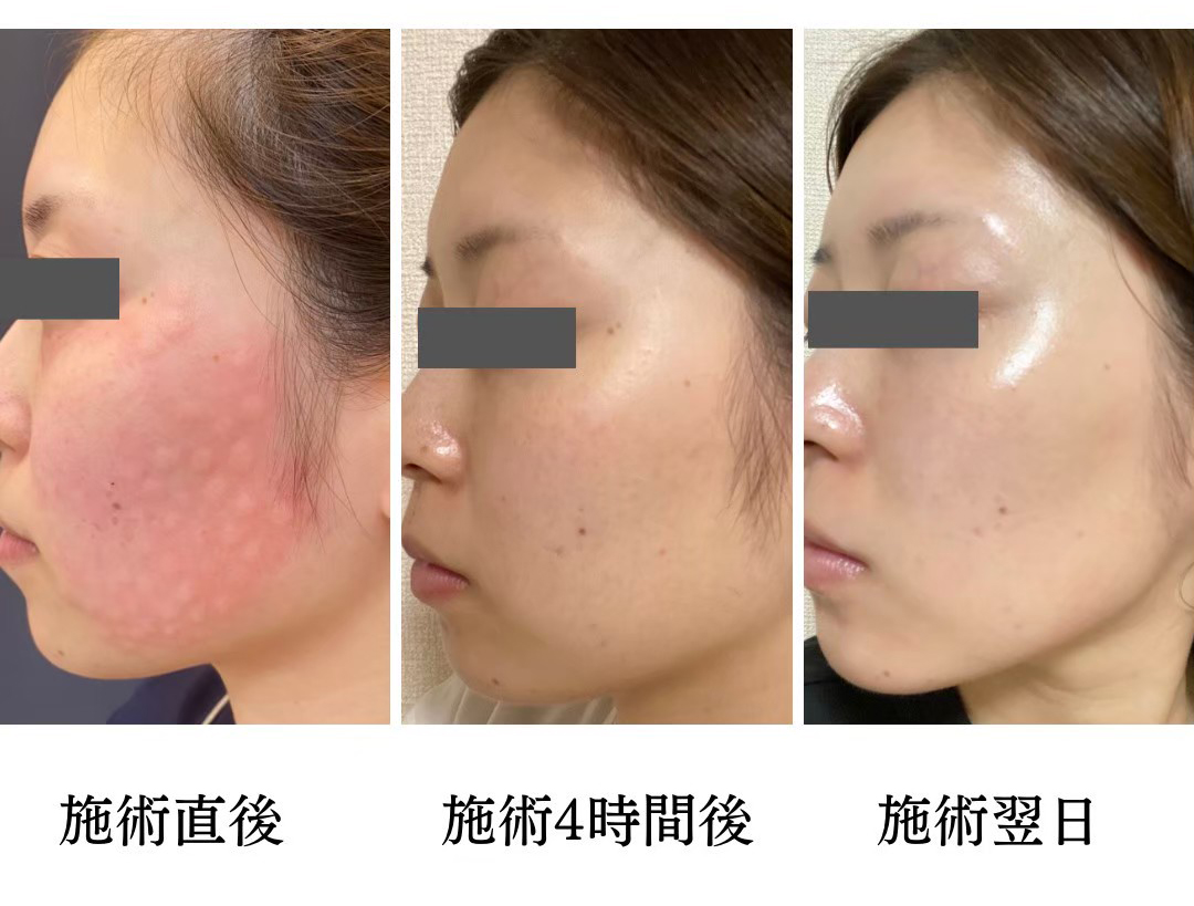 肌育ダウンタイム画像